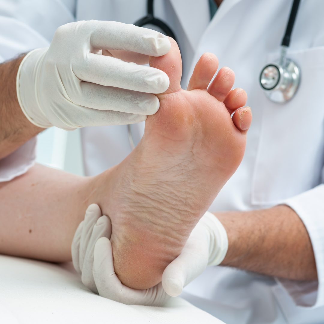 Diabetic Foot Care A Critical Step Advanced Foot Care